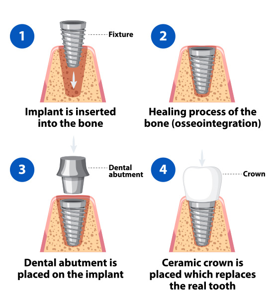 Procedure of Dental Implants in Virginia